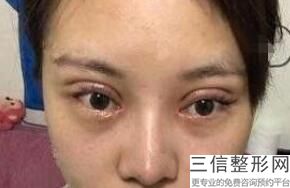 达州做去眼袋整形医院排名榜五强了解下,达县整形医院哪家好