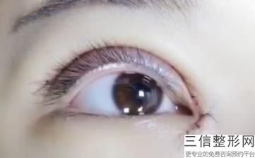 大连割双眼皮医院排名榜前十名单汇总,大连哪家割双眼皮良好