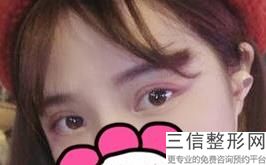 大连去眼袋整形医院排行榜top3,大连哪里做眼袋效果好的