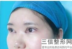 大连去眼袋整形医院排行榜top3,大连哪里做眼袋效果好的