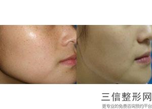 大庆热玛吉官方授权医院有哪些,大连热玛吉官方授权医院