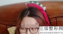 东莞割双眼皮整形医院排名前十安排,东莞割双眼皮三甲医院