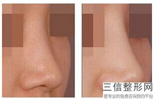 东莞隆鼻整形医院排名榜三强盘点,东莞比较有名的整形医院是哪家