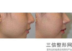 东莞隆鼻整形医院排名榜三强盘点,东莞比较有名的整形医院是哪家