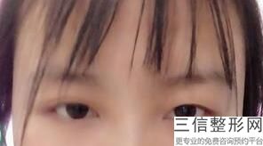 佛山双眼皮整形医院排名前十名单表,佛山整形双眼皮医院哪家好