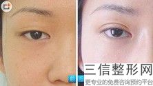 佛山双眼皮整形医院排名前十名单表,佛山整形双眼皮医院哪家好