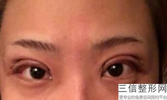 佛山眼袋去除排行榜前六名单不私藏了,佛山去眼袋哪家强