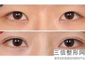 佛山眼袋去除排行榜前六名单不私藏了,佛山去眼袋哪家强