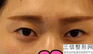 佛山眼袋去除排行榜前六名单不私藏了,佛山去眼袋哪家强