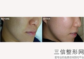 佛山做热玛吉的公立医院排行榜前五的,广州可以做热玛吉的医院