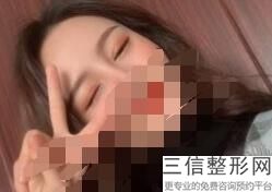 福建双眼皮整形医院排行榜前十更新,福建割双眼皮良好的医院