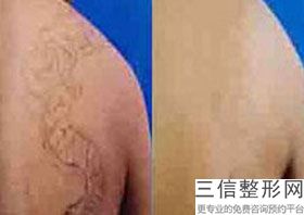 福州做热玛吉的公立医院排行榜,福州附一热玛吉