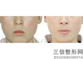 福州做热玛吉的公立医院排行榜,福州附一热玛吉