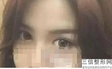 福州做双眼皮整形医院排行榜前十宣布,福州什么医院割双眼皮比较好