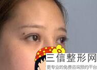 割双眼皮可以去正规医院哪家好,割双眼皮去哪家医院比较好