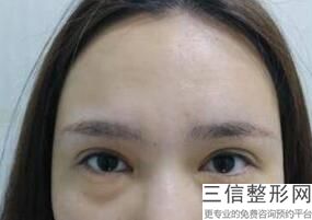 割双眼皮可以去正规医院哪家好,割双眼皮去哪家医院比较好
