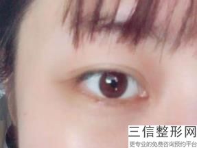 杭州哪家三甲医院割双眼皮好,杭州哪里割双眼皮比较好的医院