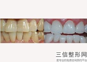 杭州哪家医院种植牙技术好,杭州种植牙科有哪些医院