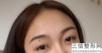 杭州去眼袋哪家医院比较好,杭州哪个三甲医院去眼袋良好
