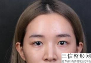 杭州去眼袋哪家医院比较好,杭州哪个三甲医院去眼袋良好
