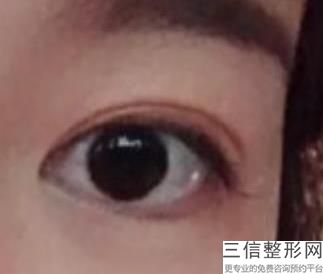 杭州去眼袋哪家医院比较好,杭州哪个三甲医院去眼袋良好