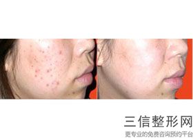 杭州热玛吉官方授权医院排名公布,杭州第一人民医院有热玛吉吗