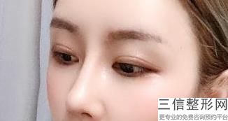 杭州双眼皮整形医院排名前十逐一发布,杭州整形医院 双眼皮