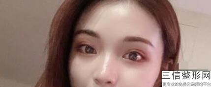 杭州双眼皮整形医院排名前十逐一发布,杭州整形医院 双眼皮