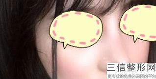 杭州驼峰鼻整形医院排名榜前八口碑推荐,杭州隆鼻哪里好