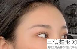 杭州网红整形医院双眼皮修复手术排行前五名揭晓,杭州做双眼皮修复吗