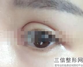 杭州眼部手术整形医院排行榜top10公开发布,杭州眼部整形价格