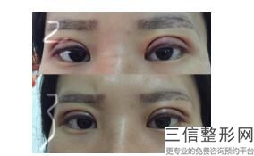杭州眼部手术整形医院排行榜top10公开发布,杭州眼部整形价格