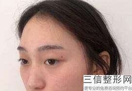 杭州整形医院做双眼皮排名榜五强推荐,杭州整形医院 双眼皮