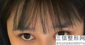 杭州整形医院做双眼皮排名榜五强推荐,杭州整形医院 双眼皮
