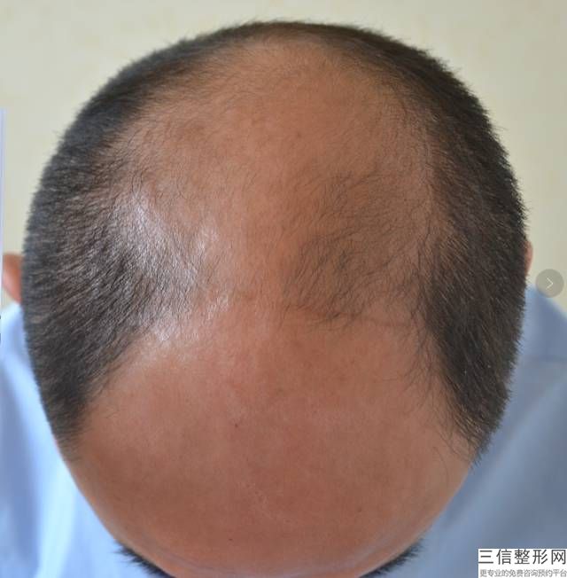 杭州植发正规三甲医院排行前三揭晓,杭州排名前十植发医院