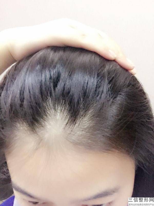 杭州植发正规三甲医院排行前三揭晓,杭州排名前十植发医院