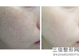 杭州做热玛吉的公立医院排行榜,杭州热玛吉五代官方授权医院