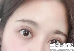 合肥割双眼皮医院排名榜前三名单出炉,合肥哪家割双眼皮良好