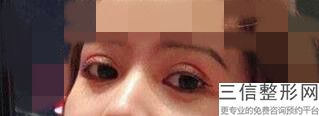 合肥割双眼皮整形医院排名榜十强汇总,合肥割双眼皮哪家医院比较好