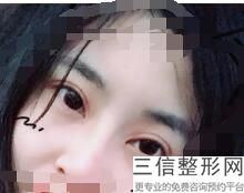 合肥割双眼皮整形医院排名榜十强汇总,合肥割双眼皮哪家医院比较好