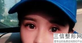 合肥埋线双眼皮哪家好,合肥哪家医院做双眼皮好