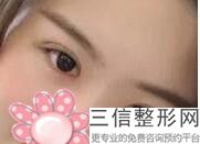 合肥埋线双眼皮哪家好,合肥哪家医院做双眼皮好
