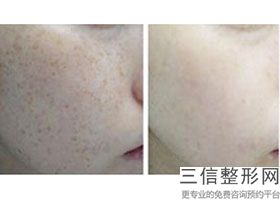 合肥热玛吉官网认证机构排行名单汇总,杭州热玛吉官网认证的机构