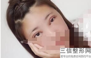 合肥双眼皮整形医院排名榜top5深度盘点,合肥良好的双眼皮整形医院