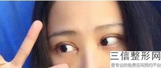 合肥双眼皮整形医院排名榜前八强实力选出,合肥哪个整形医院做双眼皮比较好