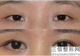 河南南阳双眼皮整形医院排名前七哪家好,南阳整形医院排名榜