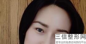 河南省双眼皮整形医院排名榜前五挨家点评,河南哪个整形医院双眼皮做的比较好