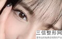 河南省双眼皮整形医院排名榜前五挨家点评,河南哪个整形医院双眼皮做的比较好