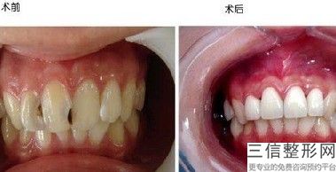 河南省种植牙口腔医院排名榜前五实力评测,河南省种植牙医院哪个好