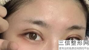 河南整形医院做双眼皮排名前八专业测评,河南整形美容医院双眼皮